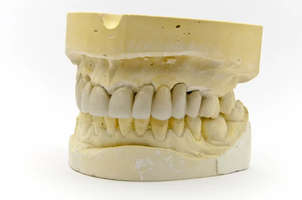牙科假牙 — 图库照片