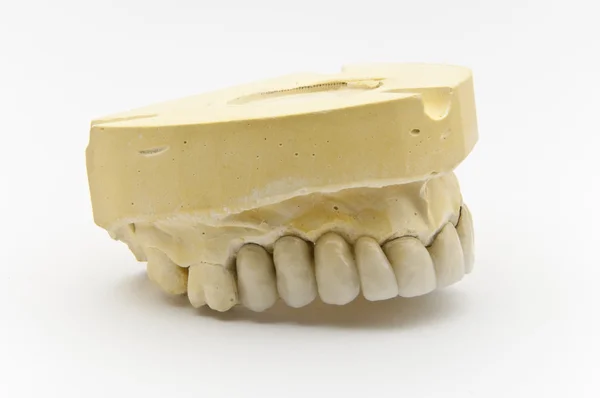 Prótesis dental Imagen de stock