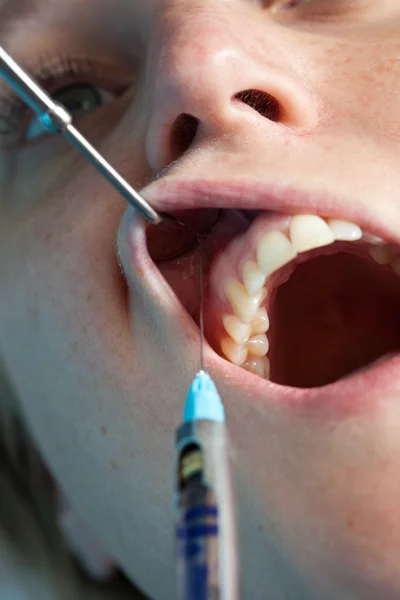 Anestética dental — Foto de Stock