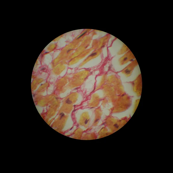 Tissu myocardique cicatrical — Photo