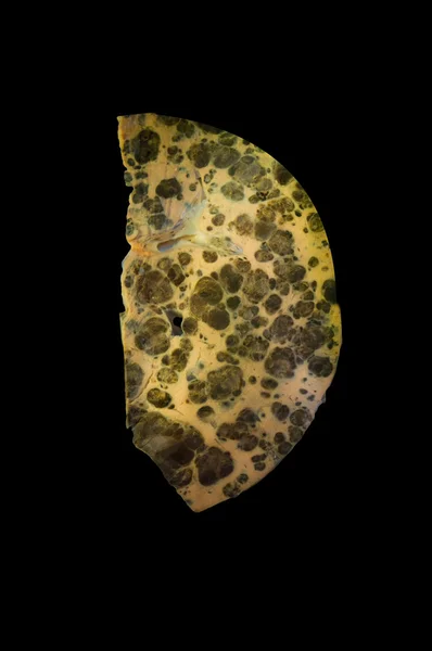 Metastases of melanoma in liver — Stock Photo, Image