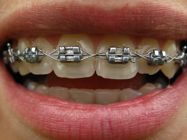 stock image Teeth and orthodontic unit