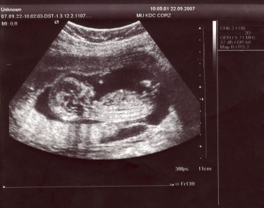 Sonogram of the baby clipart