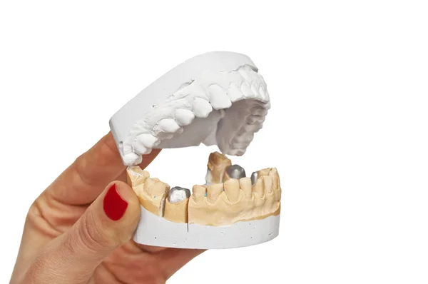 Model wgniecenia w rękach lekarzy dentystów — Zdjęcie stockowe