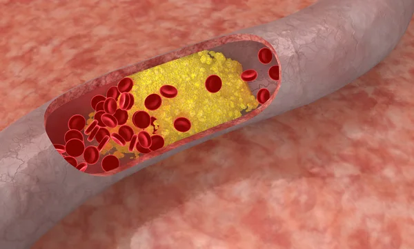 Налет на холестерин в артерии — стоковое фото