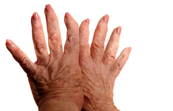 关节炎的手 — 图库照片